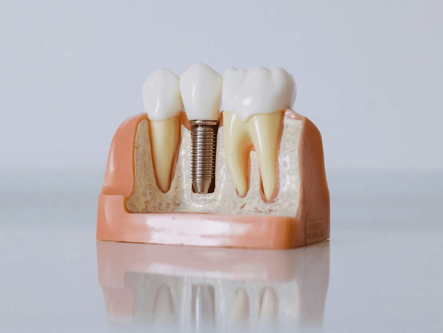 Implant dentaire
